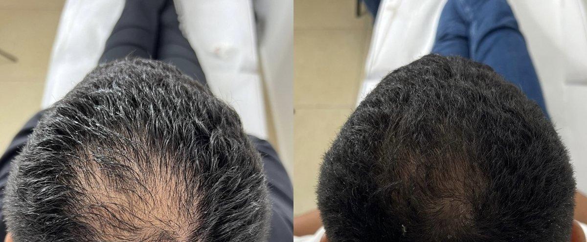 מטופל 2 — לפני ואחרי טיפול PRP לשיער (תוצאה אמיתית)