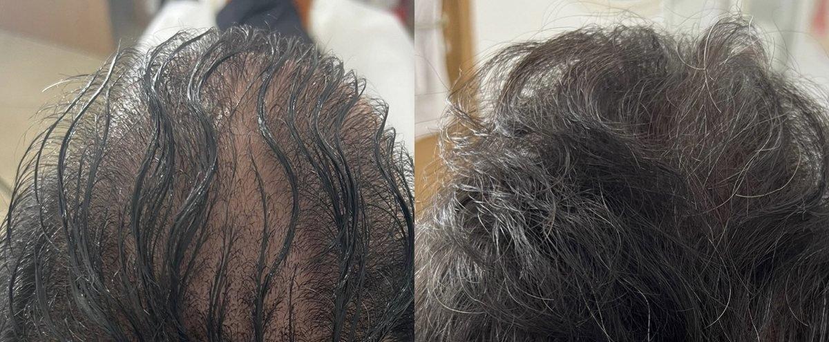 מטופל 3 — לפני ואחרי טיפול PRP לשיער (תוצאה אמיתית)